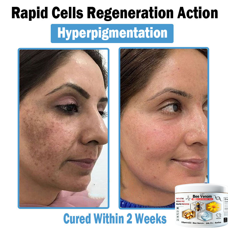 Hudros® Bee Venom Multi-Symptom Skin Treatment Cream 🌟Extra 30% off on sale items!