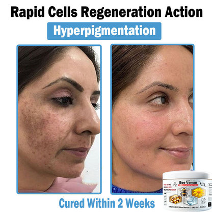 Hudros® Bee Venom Multi-Symptom Skin Treatment Cream 🌟Extra 30% off on sale items!