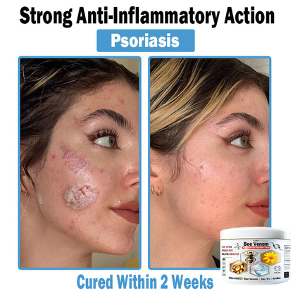 Hudros® Bee Venom Multi-Symptom Skin Treatment Cream 🌟Extra 30% off on sale items!