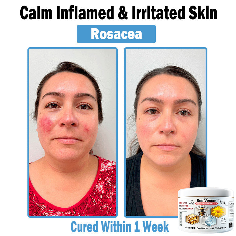 Hudros® Bee Venom Multi-Symptom Skin Treatment Cream 🌟Extra 30% off on sale items!